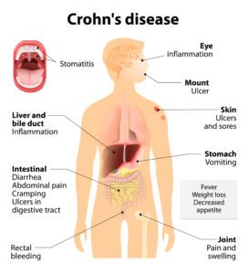 What is Crohn’s Disease